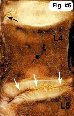 disc pain idd degeneration disease discogenic does disruption internal spine intervertebral degenerative mri